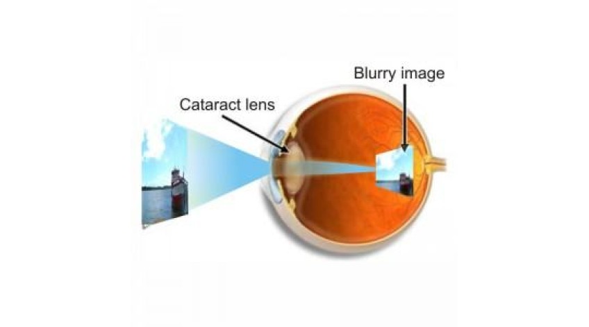 ΔΙΑΤΡΟΦΙΚΕΣ ΣΥΜΒΟΥΛΕΣ ΓΙΑ ΤΟΝ ΚΑΤΑΡΡΑΚΤΗ