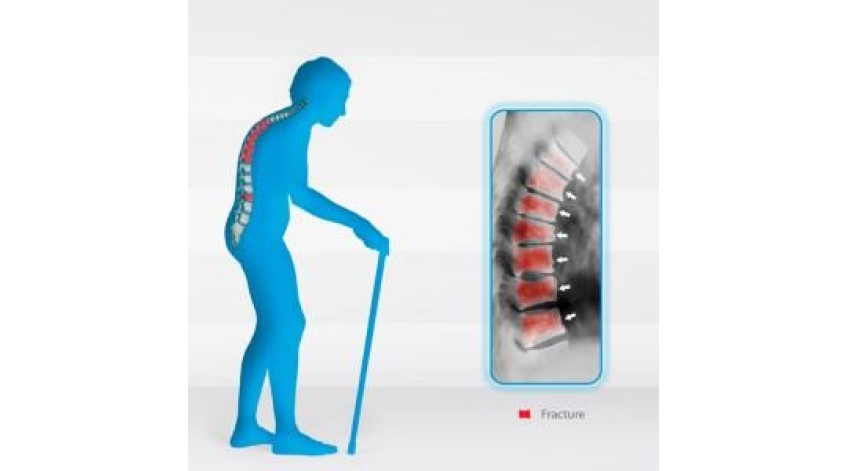 ΣΥΜΒΟΥΛΕΣ ΔΙΑΤΡΟΦΗΣ ΓΙΑ ΤΗΝ ΟΣΤΕΟΠΟΡΩΣΗ