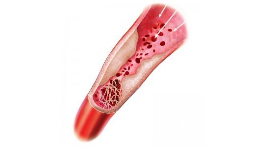 ΘΡΟΜΒΟΛΥΤΙΚΗ ΔΙΑΤΡΟΦΗ